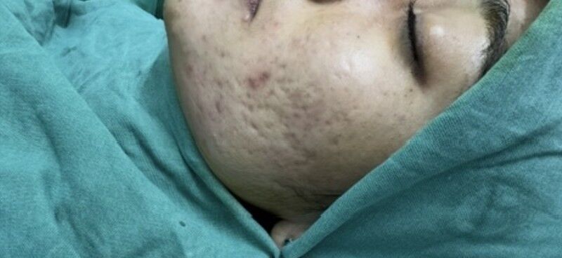 Acne Scar Treatment Before
