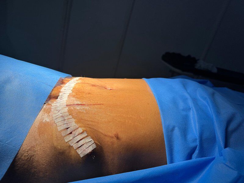 Aesthetic Gynecology After