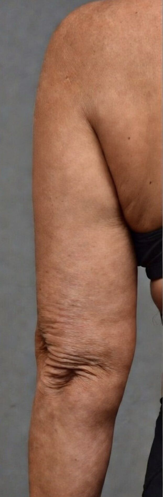 Arm Lift (Brachioplasty) Before