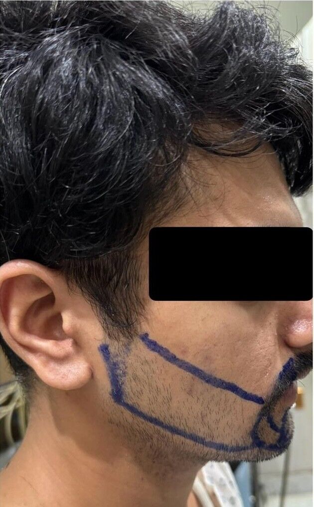 Beard Transplant Before