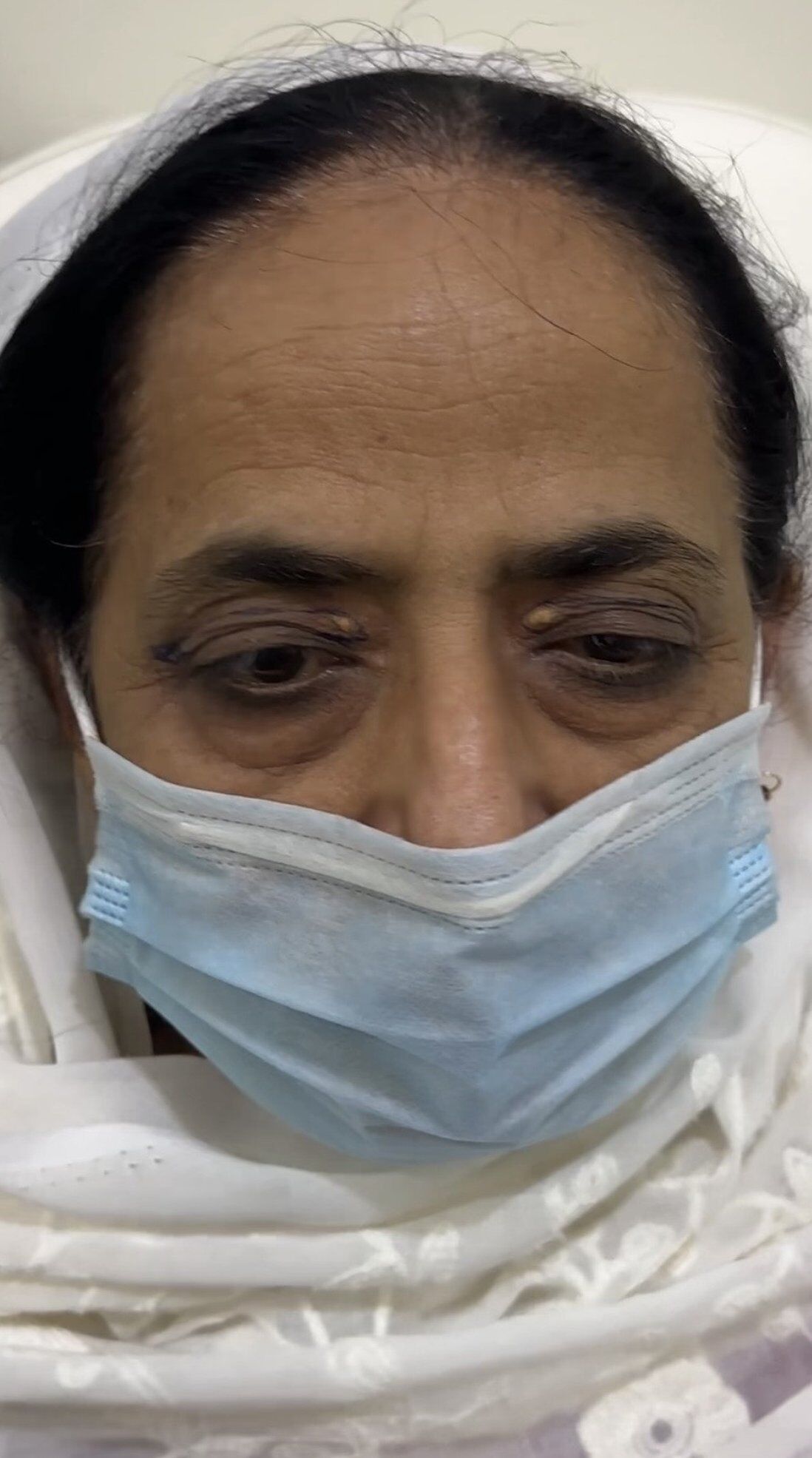 Blepharoplasty (Eyelid Surgery) Before