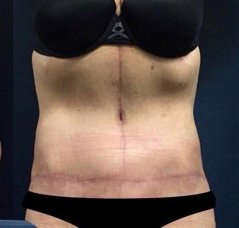 Body Contouring After Weight Loss After