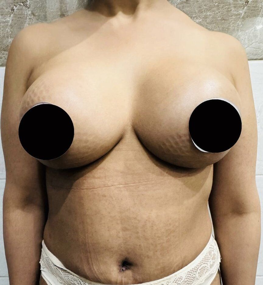 Breast Augmentation After