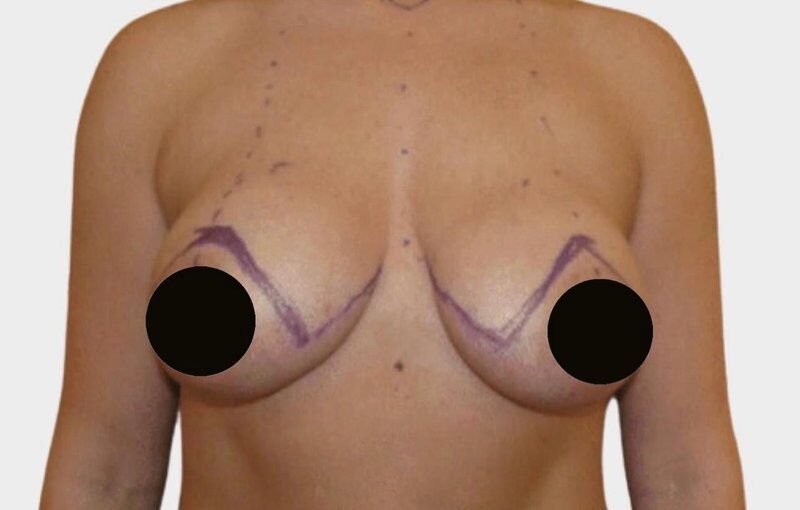 Breast Lift (Mastopexy) Before