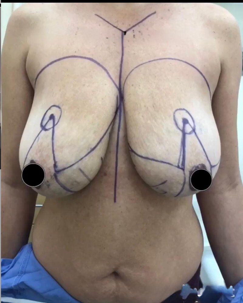 Breast Reduction Before