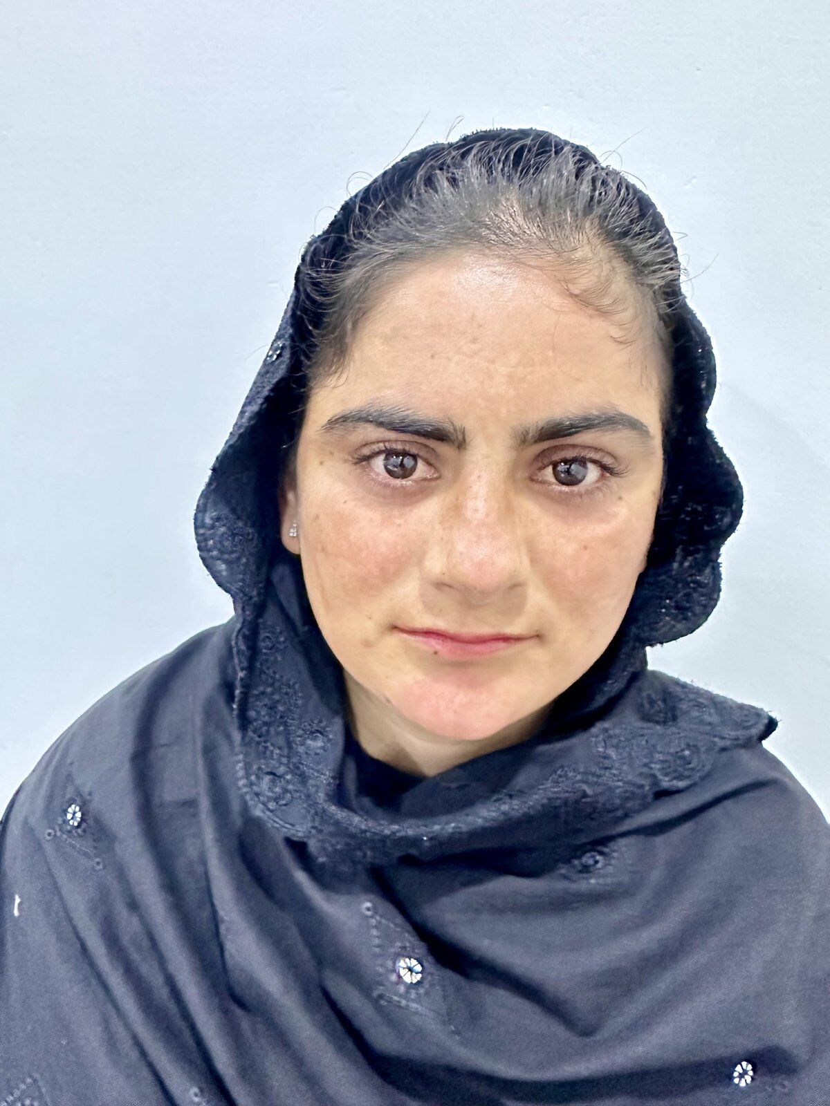 Burn Reconstruction After