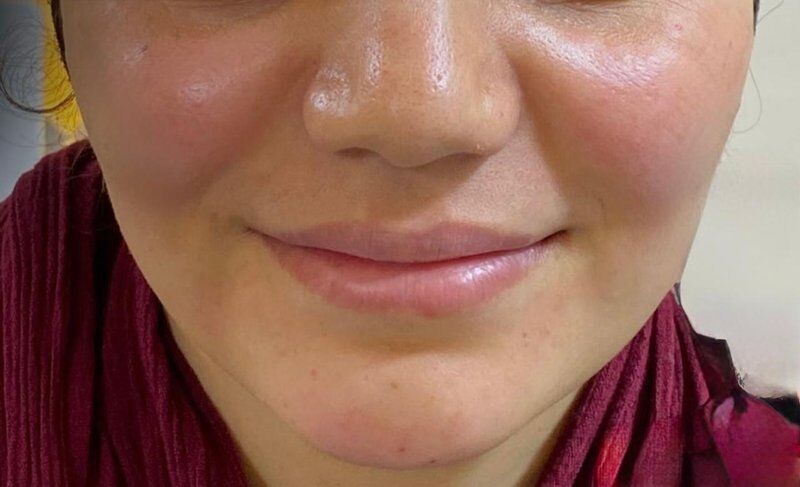 Cheek Implants (Malar Augmentation) After