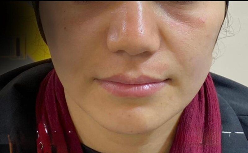 Cheek Implants (Malar Augmentation) Before