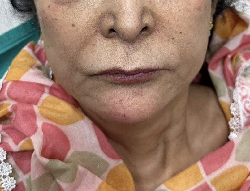 Chin Reshaping After