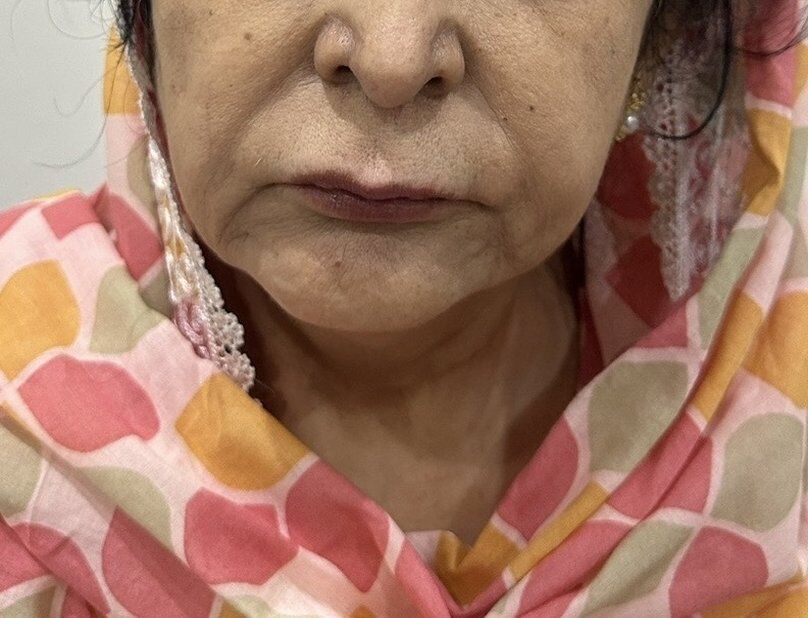 Chin Reshaping Before