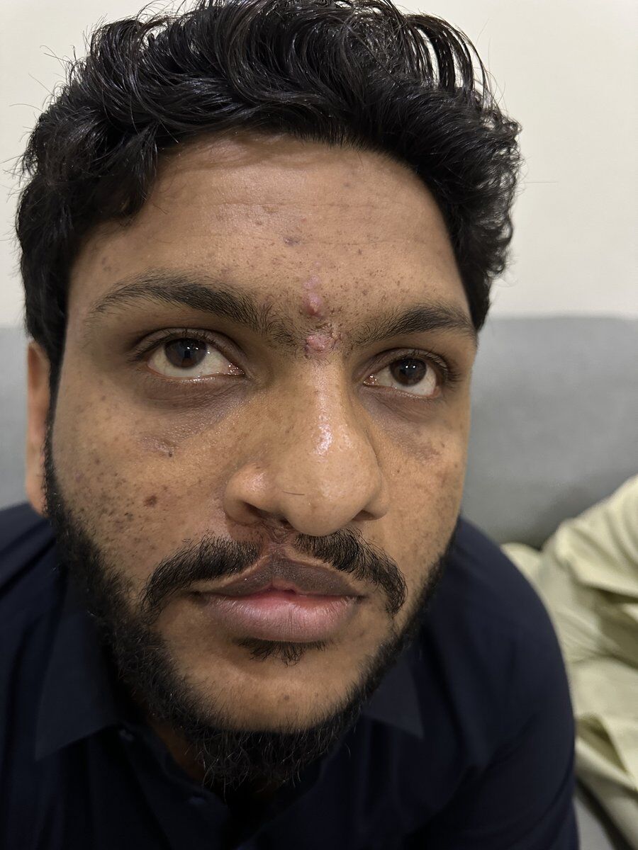 Cleft Lip & Palate Surgery Before