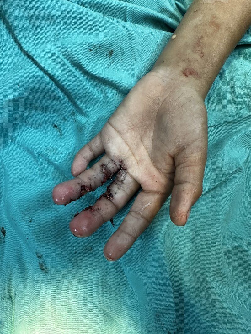 Congenital Deformities After