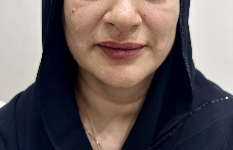 Dermal Fillers After