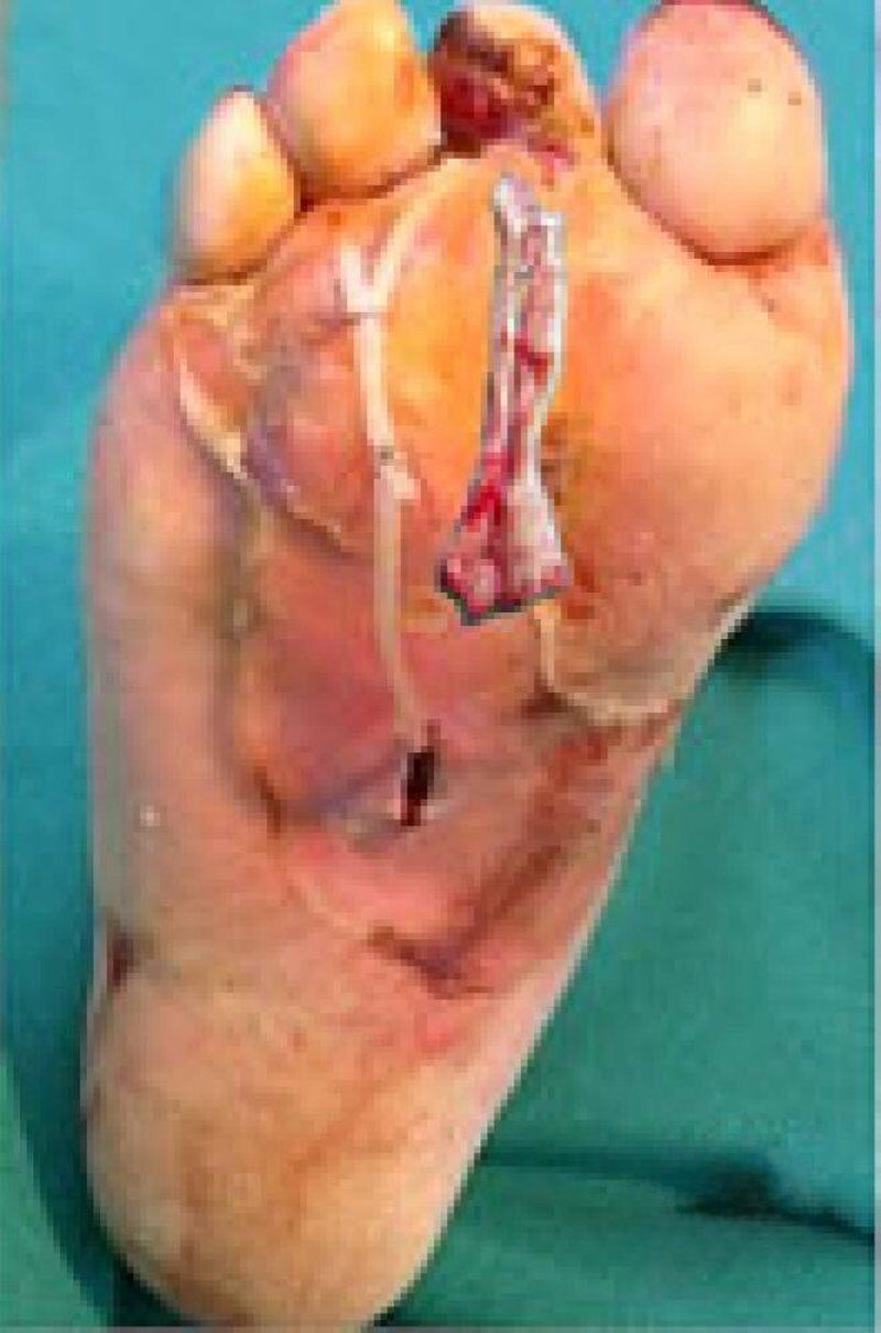 Diabetic Foot Management Before