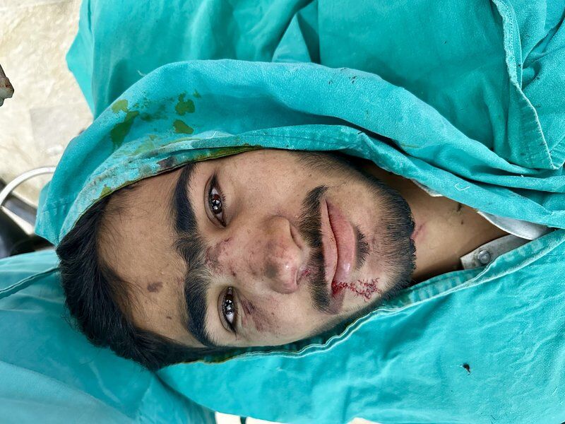 Face Trauma Reconstruction After