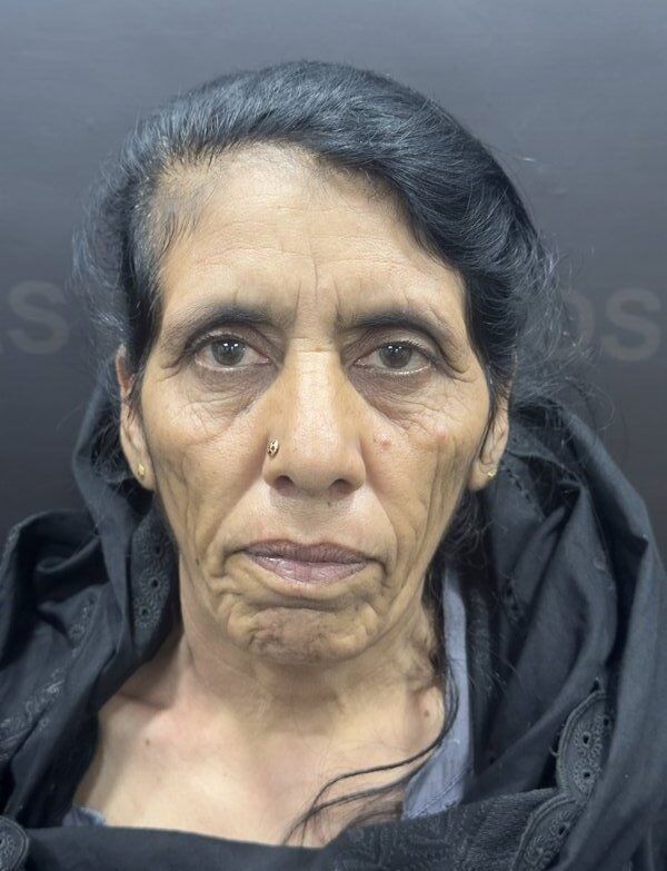 Facelift (Rhytidectomy) Before