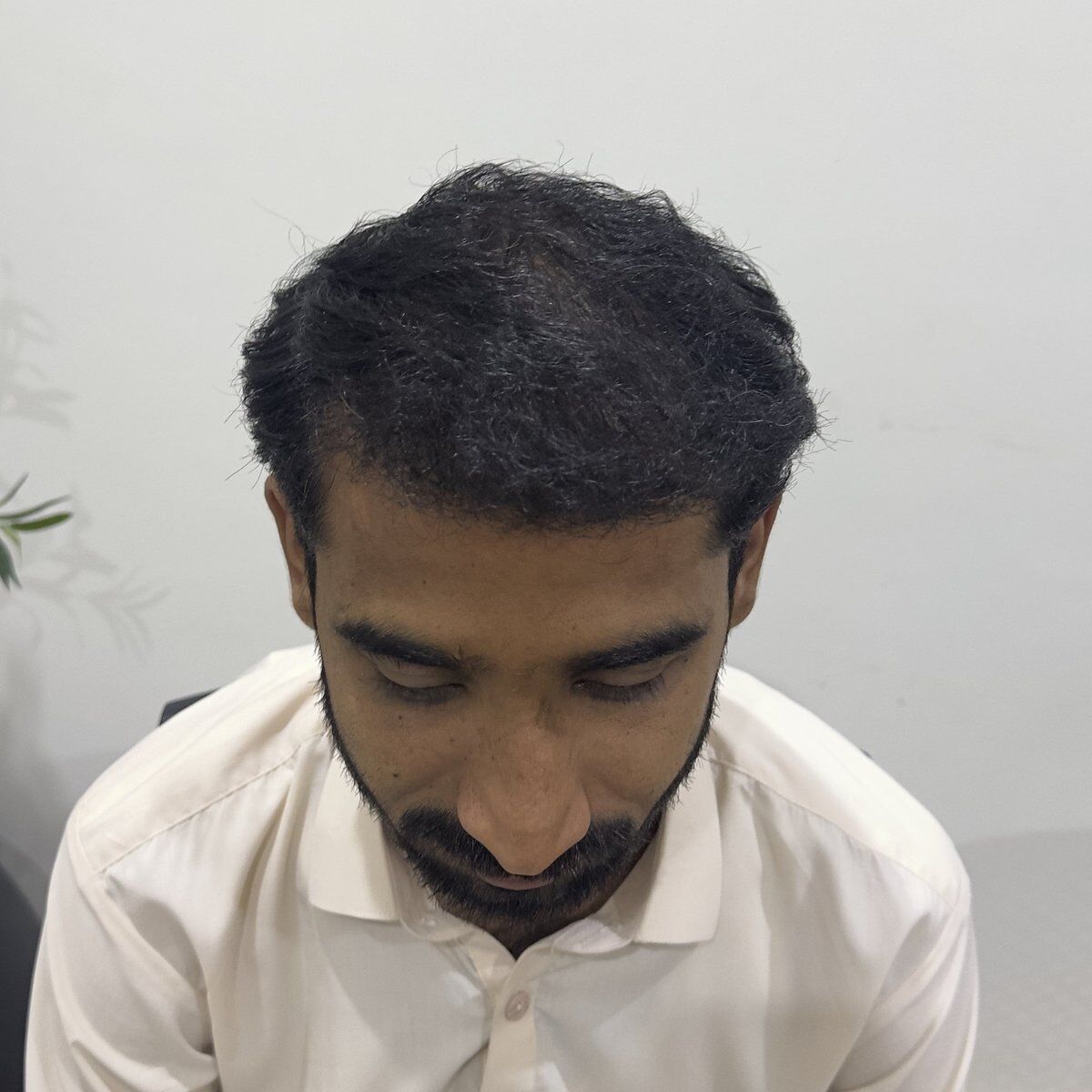 FUE Hair Transplant After