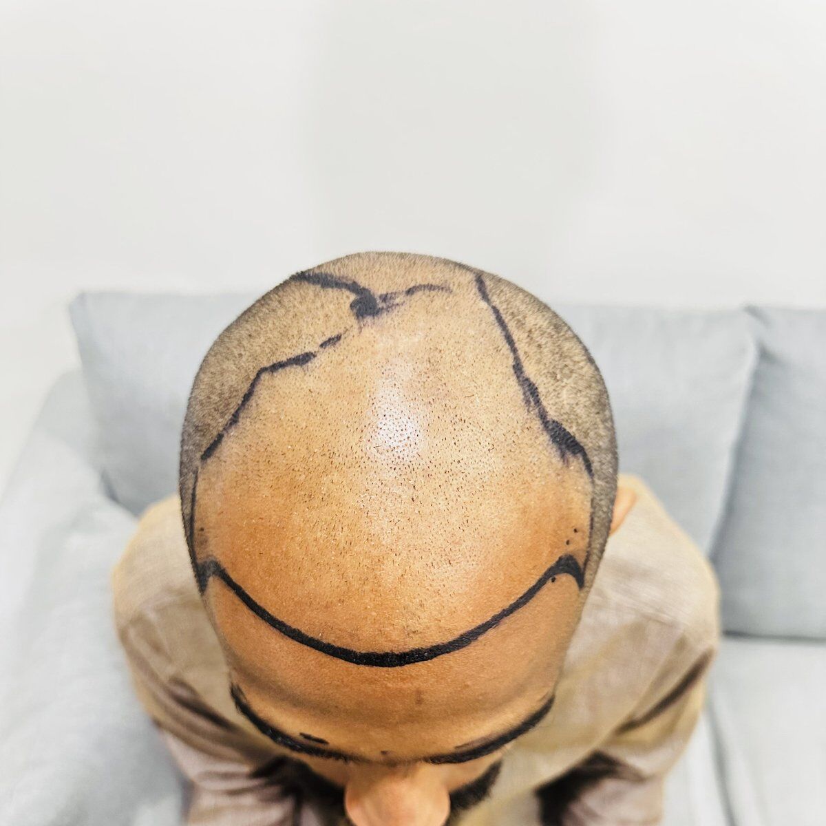 FUE Hair Transplant Before