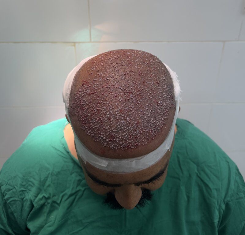 FUT Hair Transplant After