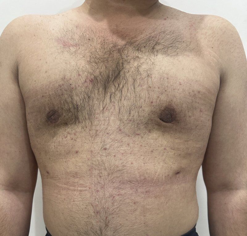 Gynecomastia (Male Breast Reduction) After
