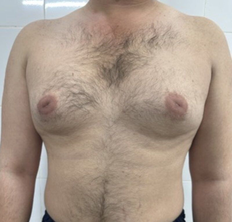 Gynecomastia (Male Breast Reduction) Before