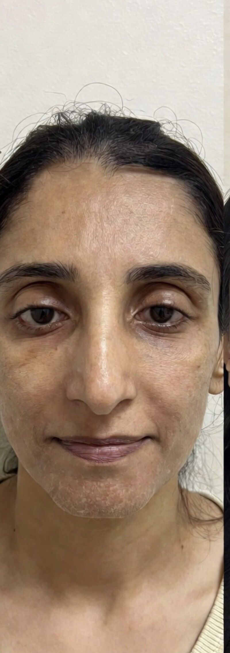 HydraFacial Before