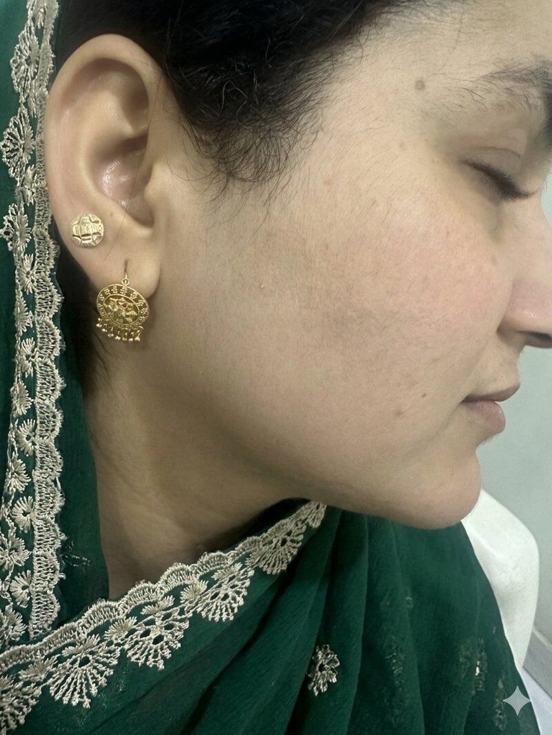 Laser Hair Removal After