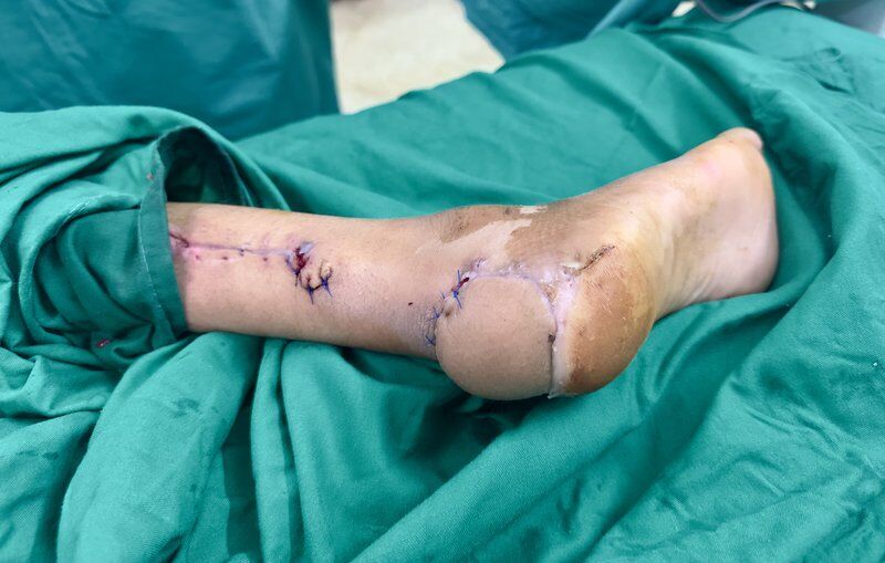 Limb Reconstruction After