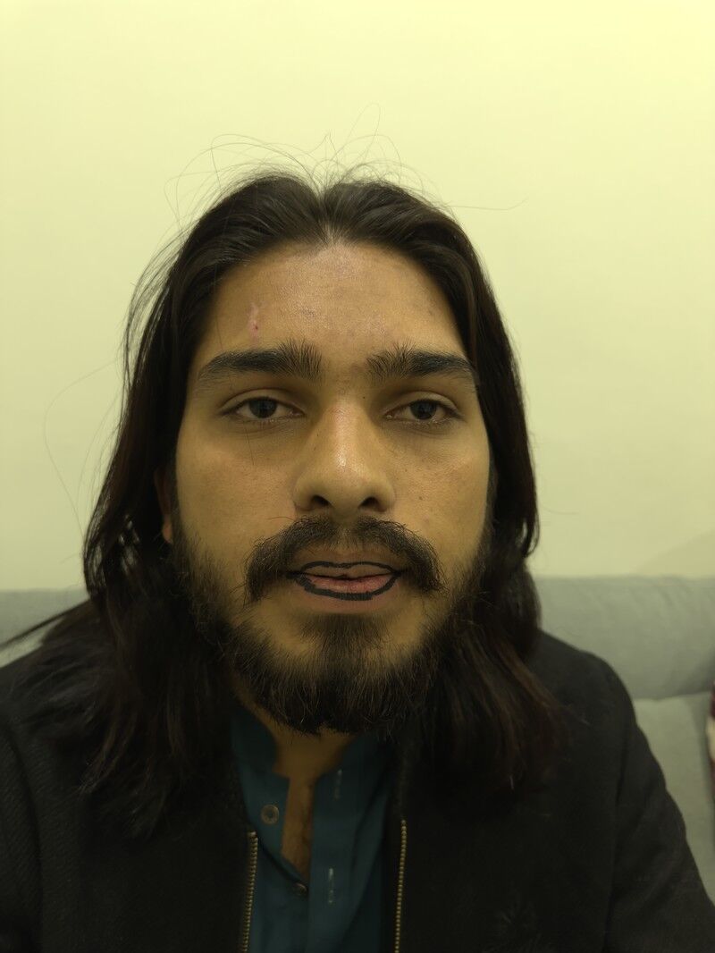 Lip Reduction Before