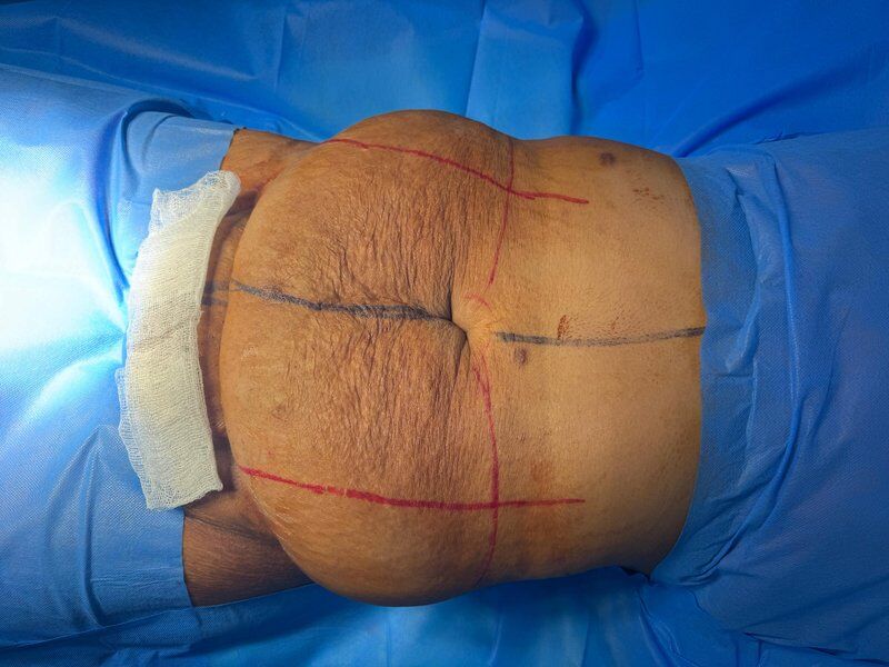 Mommy Makeover Before