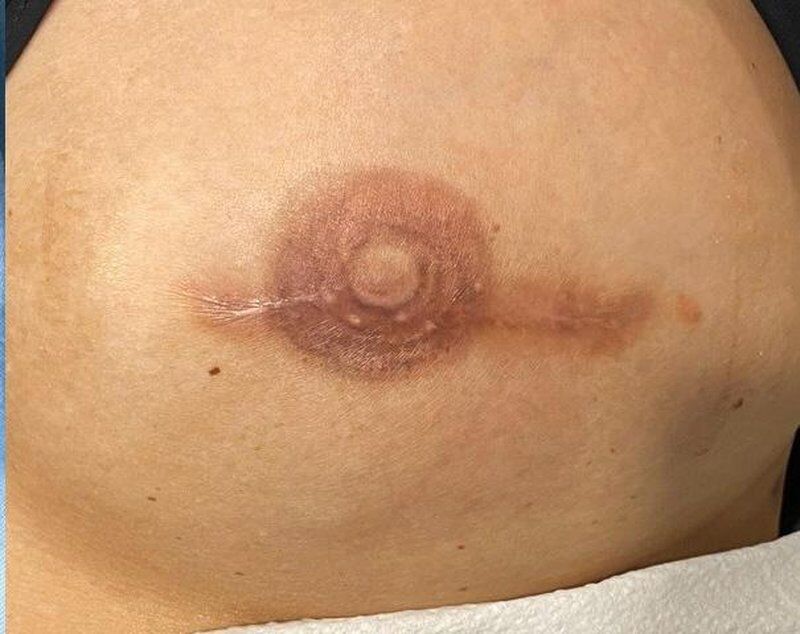 Nipple & Areola Correction After