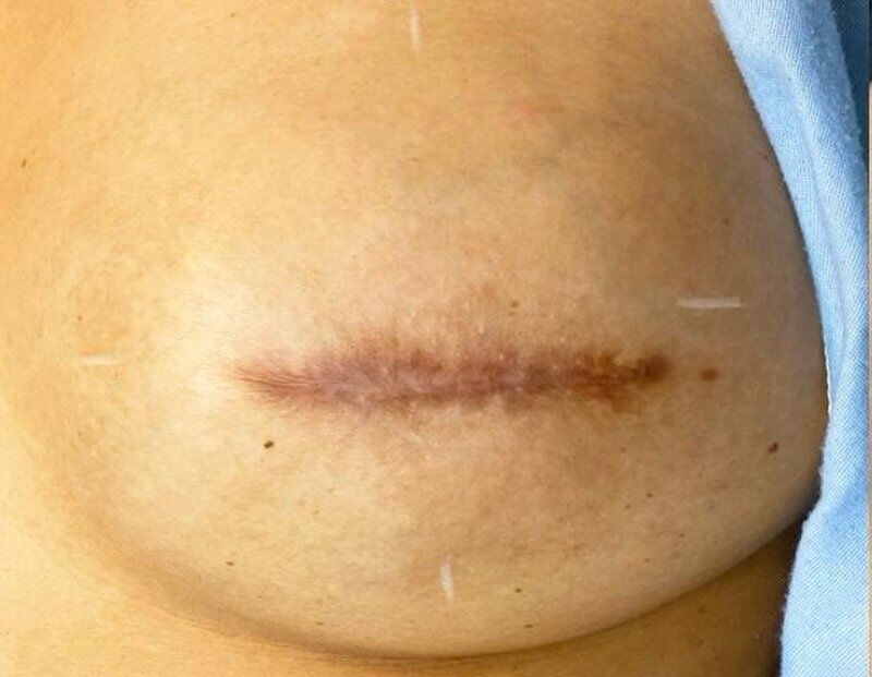 Nipple & Areola Correction Before