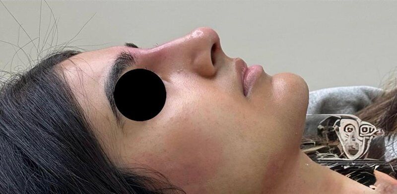 Non-Surgical Rhinoplasty After