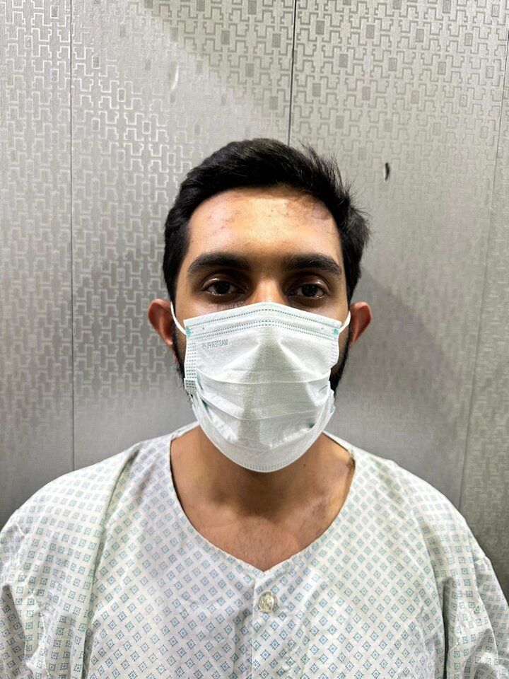 Otoplasty (Ear Reshaping) Before