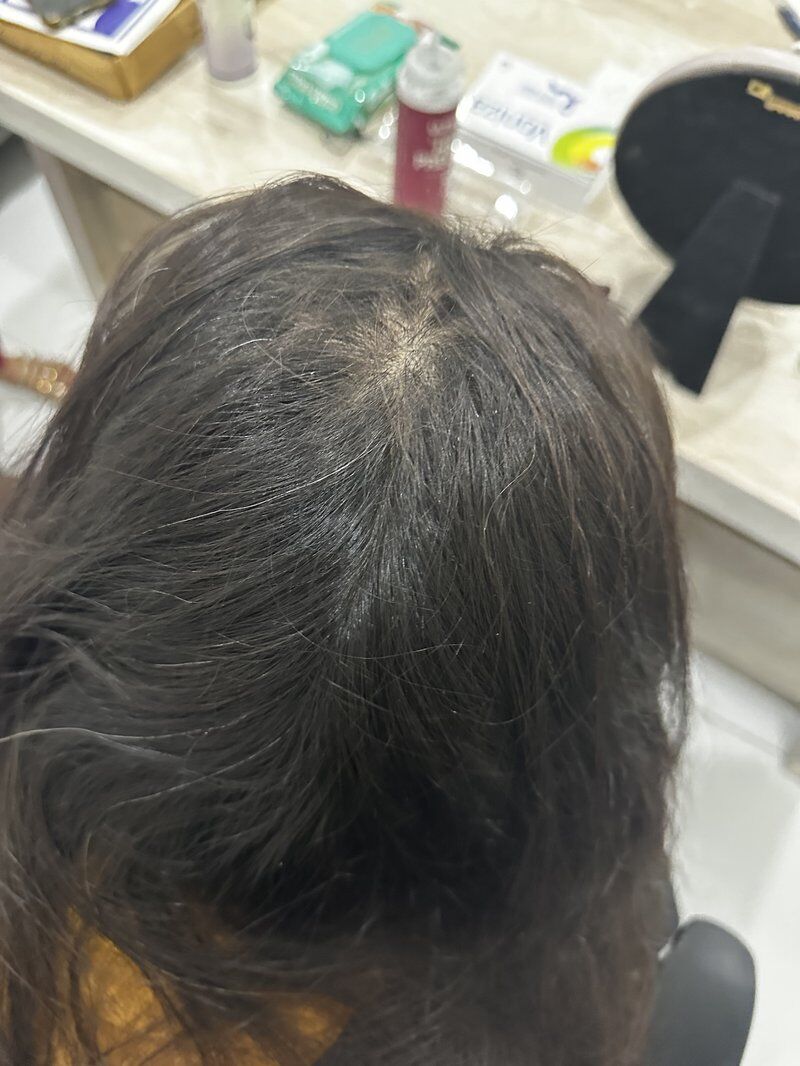 PRP Hair Therapy After