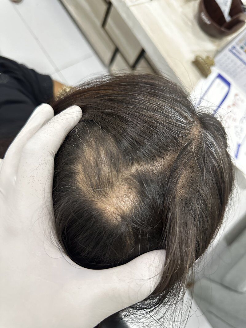 PRP Therapy (Vampire Facial) Before