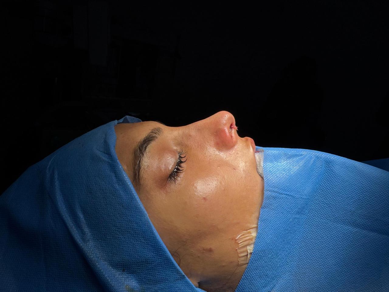 Rhinoplasty (Nose Job) After