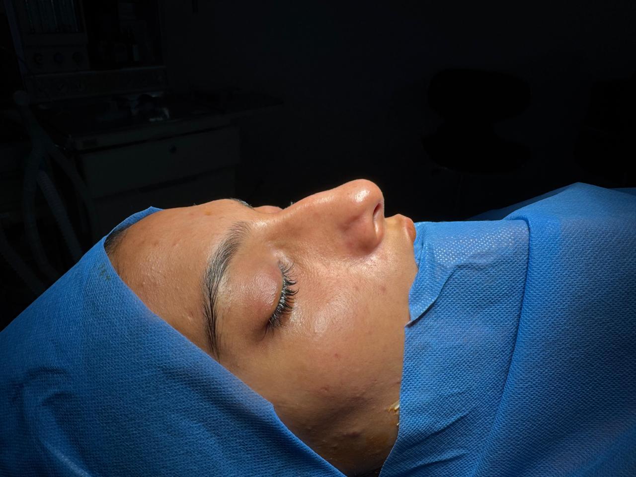 Rhinoplasty (Nose Job) Before