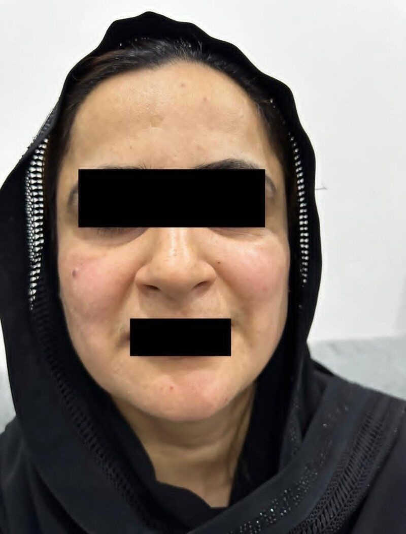 Skin Whitening & Brightening After