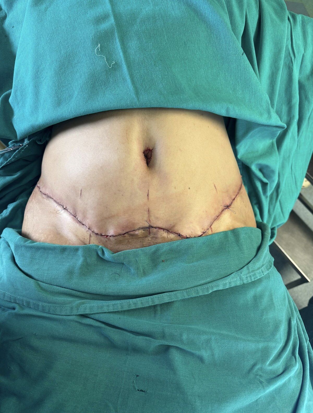 Tummy Tuck (Abdominoplasty) After