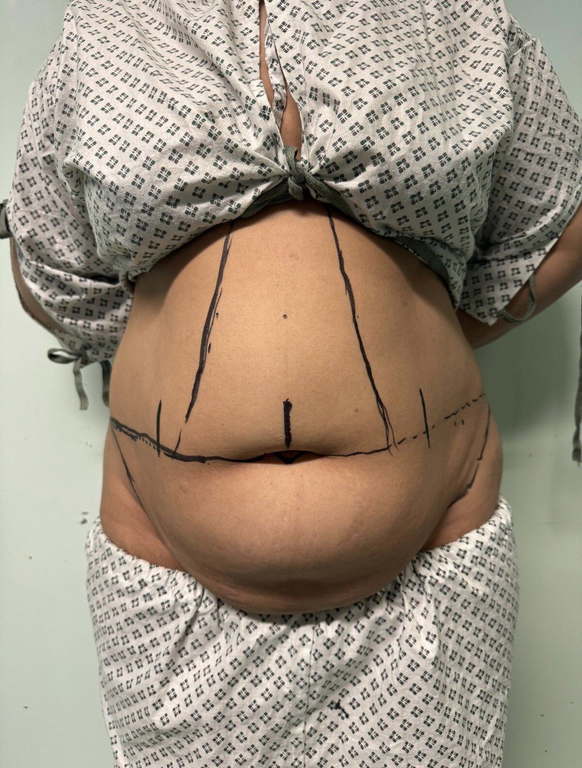 Tummy Tuck (Abdominoplasty) Before
